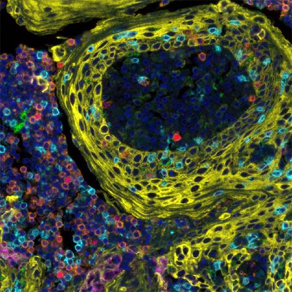 <b>Detection of human CD3 (orange), CD8 (cyan), CD68 (green), cytokeratin (yellow), FOXP3 (red) and PD-L1 (magenta) in FFPE tonsil by IHC-IF.</b> Rabbit anti-CD3E recombinant monoclonal [BL-298-5D12] (A700-016), rabbit anti-CD8 alpha recombinant monoclonal [BLR044F] (A700-044), mouse anti-CD68 monoclonal [KP-1] (A500-018A), mouse anti-cytokeratin monoclonal [AE1/AE3] (A500-019A), rabbit anti-FOXP3 recombinant monoclonal [BLR034F] (A700-034), and rabbit anti-PD-L1 recombinant monoclonal [BLR020E] (A700-020). Secondary: HRP-conjugated goat anti-rabbit IgG (A120-501P) and HRP-conjugated goat anti-mouse IgG (A90-116P). Substrate: Opal™ 480, 520, 570, 620, 690 and 780. Counterstain: DAPI (blue).