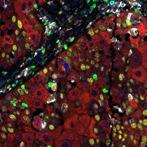 <b>Detection of human CD3 (cyan), CD8 (green), CD68 (orange), CK (red), Ki67 (yellow) and PD-L1 (white) in FFPE HNSCC by IHC-IF.</b> Rabbit anti-CD3E recombinant monoclonal [BL-298-5D12] (A700-016), rabbit anti-CD8 alpha recombinant monoclonal [BLR044F] (A700-044), mouse anti-CD68 monoclonal [KP-1] (A500-018A), mouse anti-cytokeratin monoclonal [AE1/AE3] (A500-019A), rabbit anti-Ki-67 monoclonal [BLR021E] (A700-021) and rabbit anti-PD-L1 recombinant monoclonal [BLR020E] (A700-020). Secondary: HRP-conjugated goat anti-rabbit IgG (A120-501P) and HRP-conjugated goat anti-mouse IgG (A90-116P). Substrate: Opal™ 480, 520, 570, 620, 690 and 780. Counterstain: DAPI (blue).