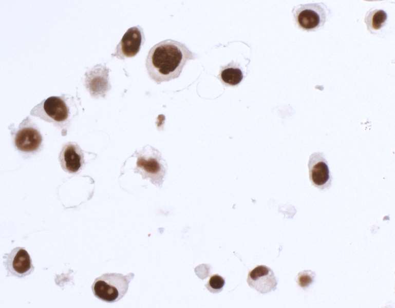 <b>Detection of human SOX10 in FFPE SK-MEL-28 cells by ICC.</b> <i>Antibody:</i> Rabbit anti-SOX10 recombinant monoclonal antibody [BLR080G] (A700-080 lot 1). <i>Secondary:</i> HRP-conjugated goat anti-rabbit IgG (A120-501P). <i>Substrate:</i> DAB.